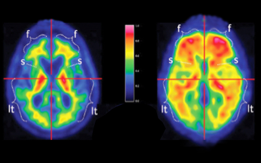 placas_beta_amiloide_sano_alzheimer