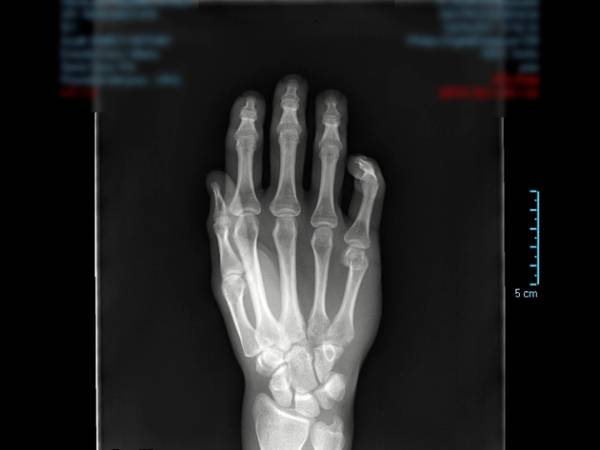 radiografía_mano_quironsalud_marbella