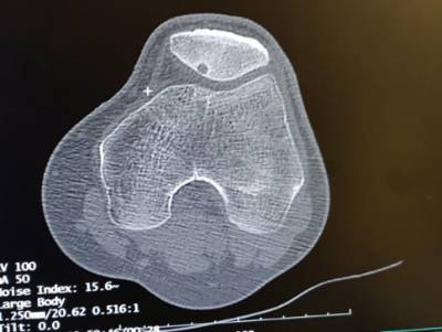 ablacion_quironsalud_marbella3