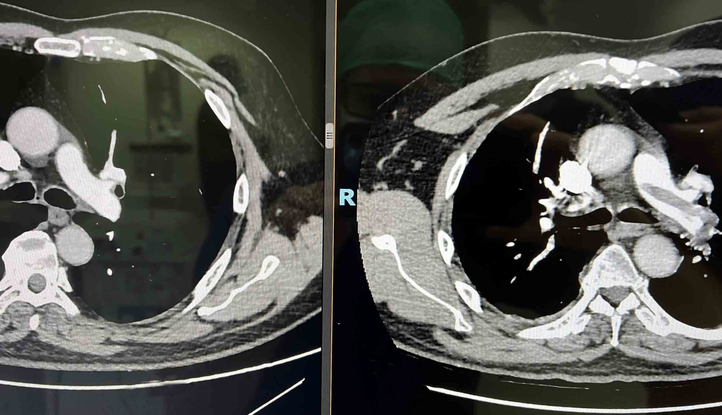 pert_tromboembolismo_pulmonar_quironsalud_marbella