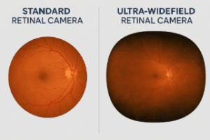 comparativa retinografía