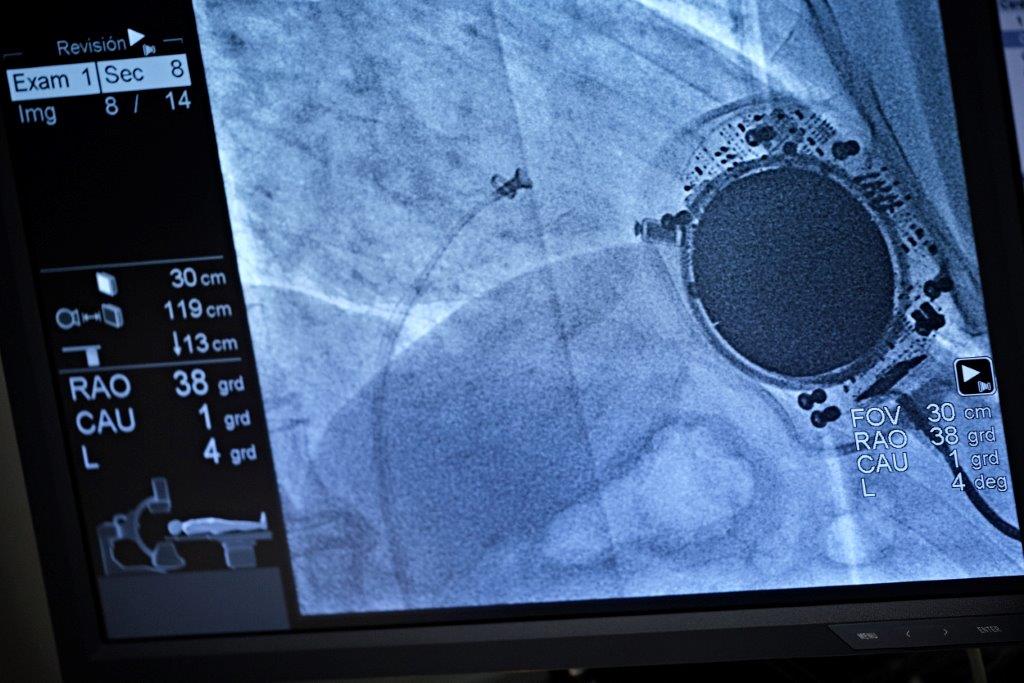 QS Tenerife coloca el primer marcapasos sin cable de la sanidad privada de la isla (1)