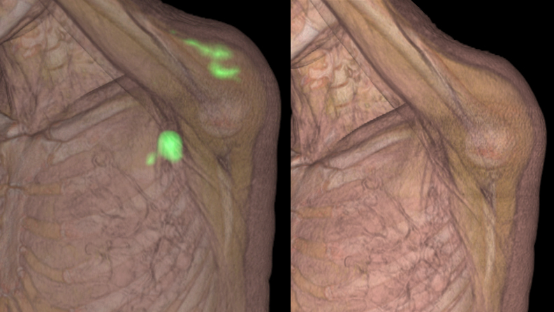 adenopatia tras vacuna