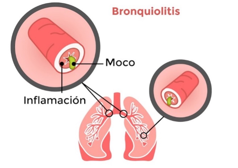 bronquiolitis