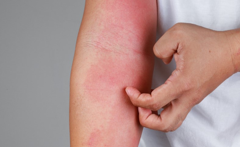 jornada-dermatitis-atopica