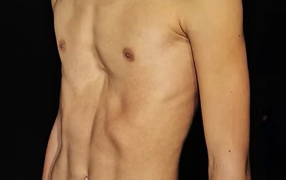 Pectus-excavatum2