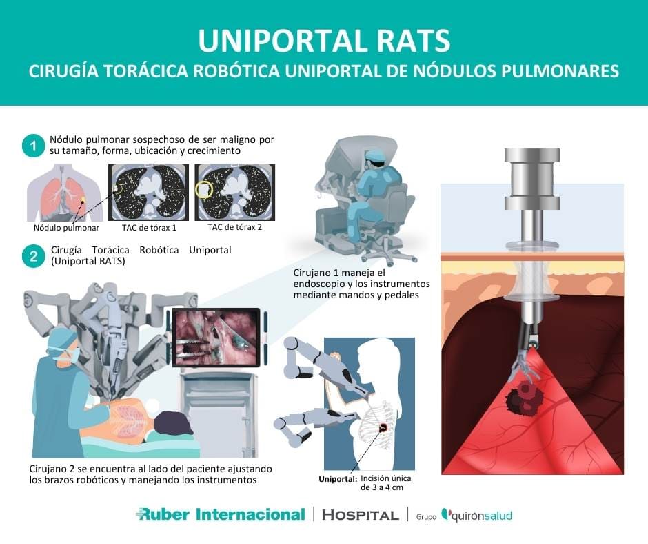 Cirugía Torácica Robótica Uniportal RATS segmentectomia