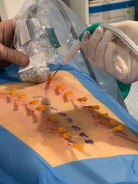 Crioanalgesia Quirónsalud Málaga