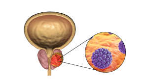 deteccion-cancer-prostata
