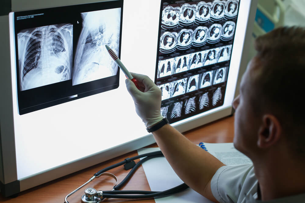 epoc-enfermedad-pulmonar-obstructiva-crónica-radiografía