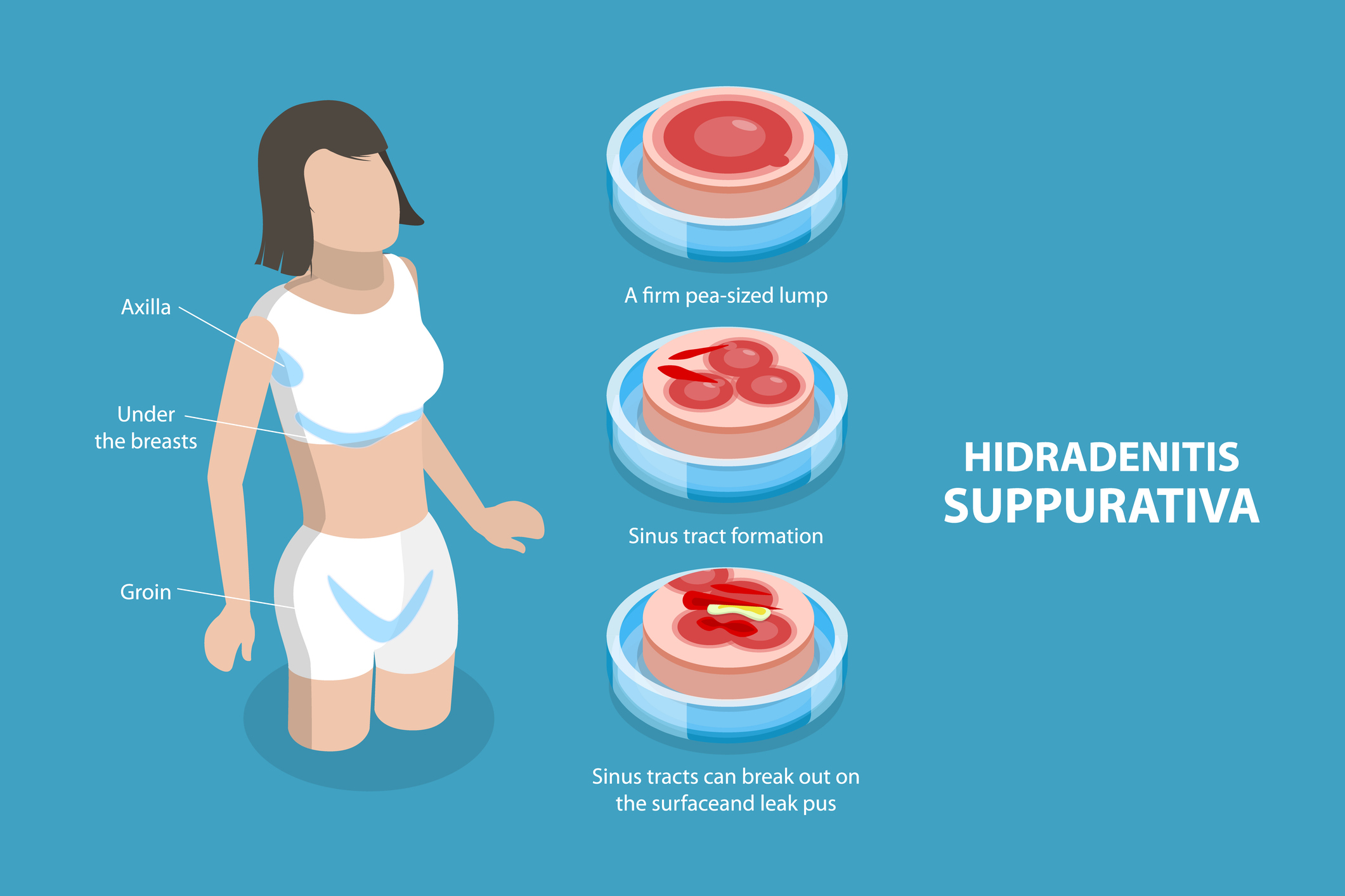 Hidradenitis supurativa