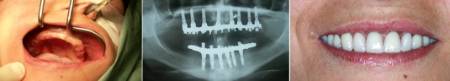 Paciente desdentada total. Hueso muy estrecho. Implantes colocados sobre injertos óseos