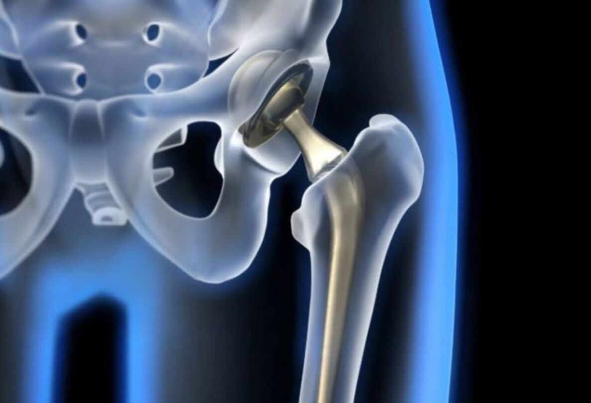 protesis-cadera-quironsalud-vitoria