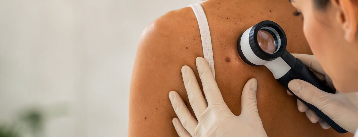 Melanoma-Dermatologia-HQSV