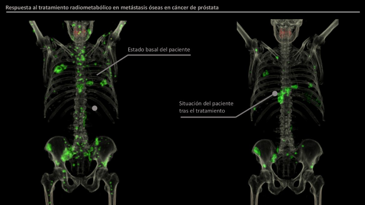 Respuesta al tratamiento radiometabólico en metástasis óseas en cáncer de próstata