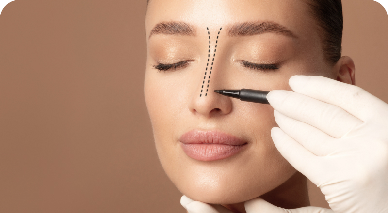 Rinoplastia
