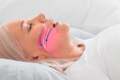 apnea dr Albares