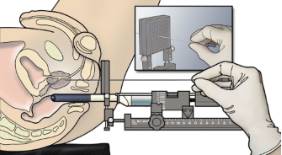 CANCER_PROSTATA_HURJC_3