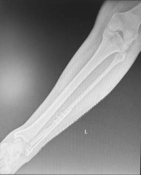 2020 07 03 Imagen del peroné reconstruído en el HURJC