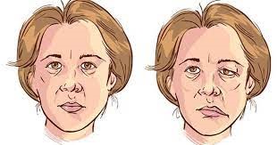 paralisis facial cabecera