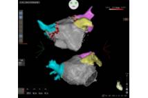 Sistema de navegación cardiaca CARTO