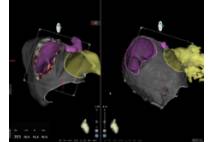 Sistema de navegación cardiaca CARTO