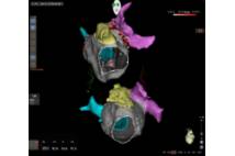Sistema de navegación cardiaca CARTO