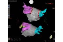 Sistema de navegación cardiaca CARTO