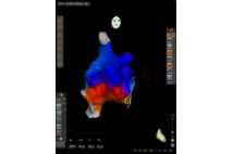 Sistema de navegación cardiaca CARTO