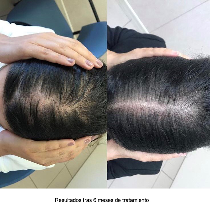 Consulta alopecia femenina Hospital Quirónsalud San José