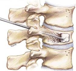elastoplastia