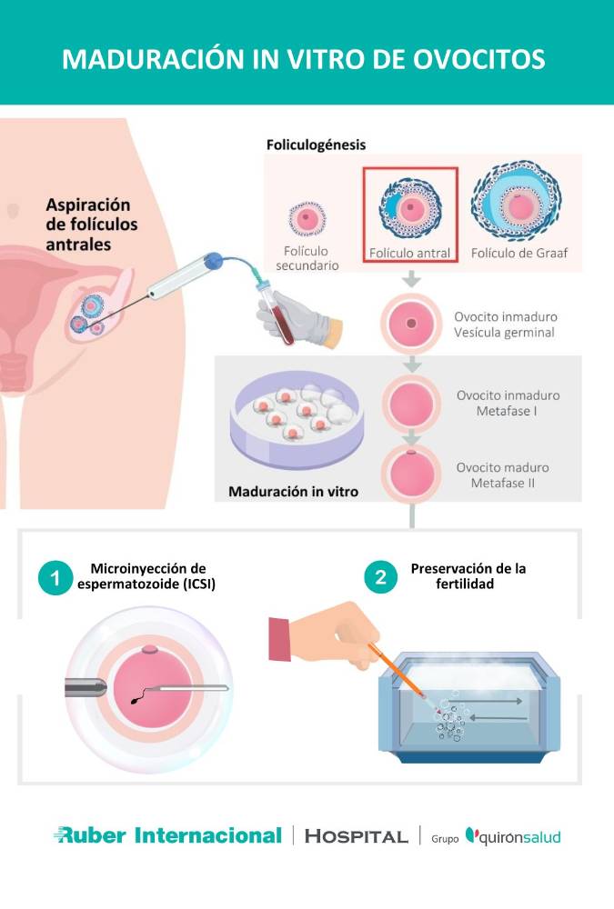 Maduración in vitro de ovocitos en reproducción asistida