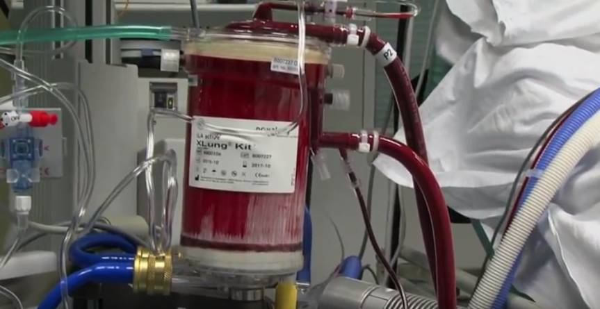 ECMO