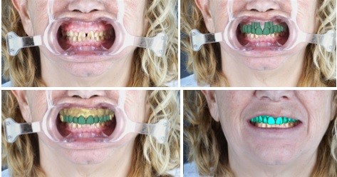 Diseño informático de la nueva sonrisa