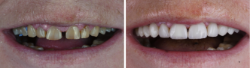 Resultado final. Antes y después del tratamiento