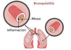 bronquiolitis