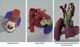 Varios ejemplos de modelos cardiacos personalizados realizados en la Unidad de Planificación Quirúrgica 3D