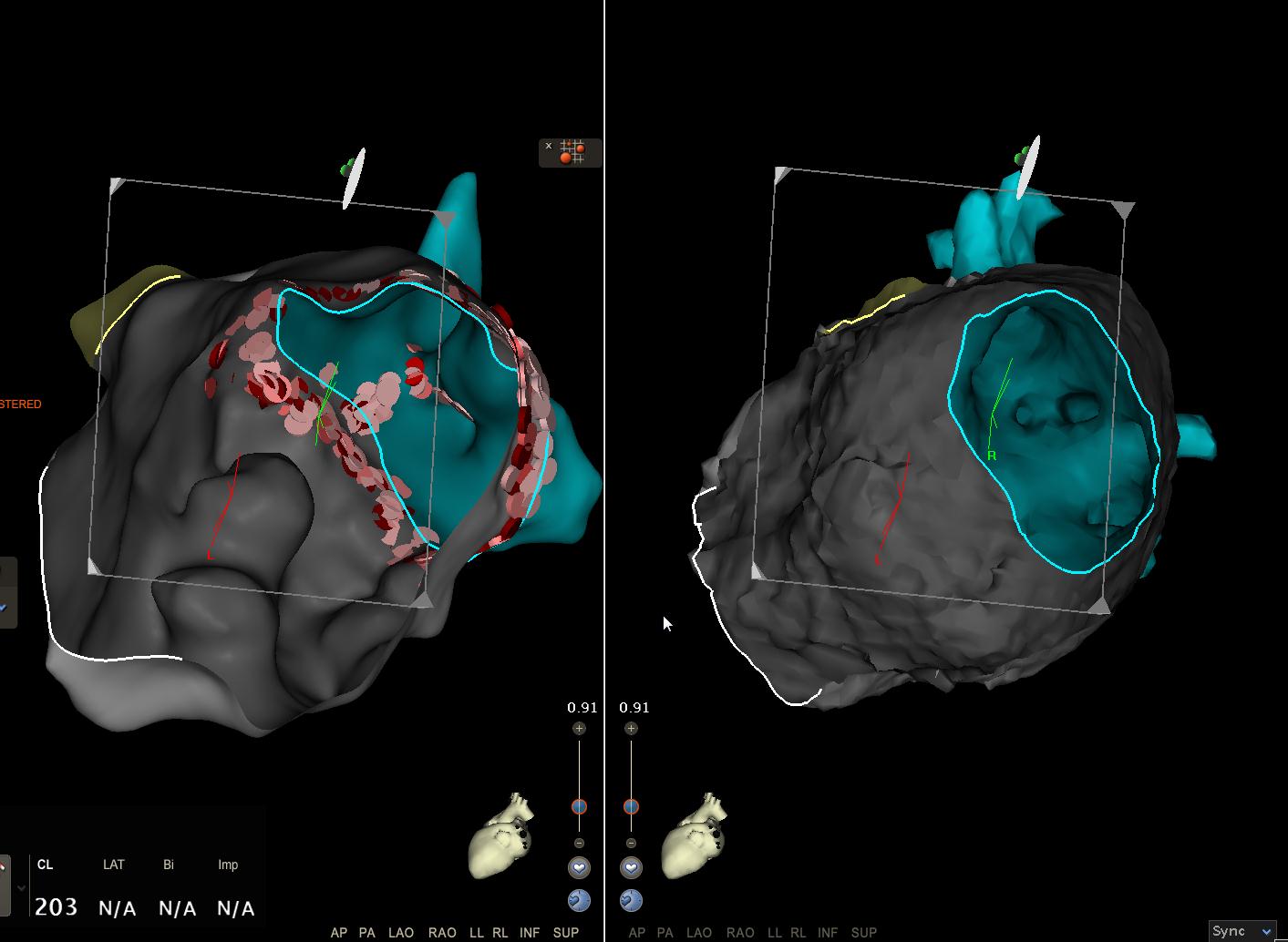 Sistema de navegación cardiaca CARTO