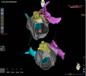 Sistema de navegación cardiaca CARTO