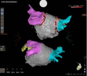 Sistema de navegación cardiaca CARTO