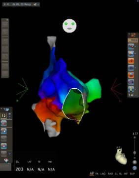 Sistema de navegación cardiaca CARTO