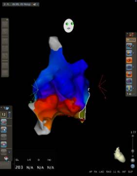 Sistema de navegación cardiaca CARTO