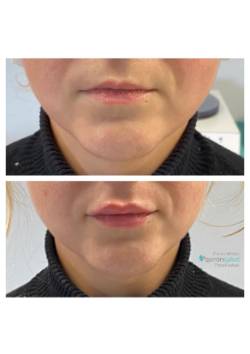 Relleno Labial (1)_page-0001