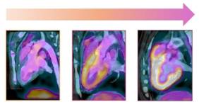 Imágenes PET (amarillo, más alteración en el uso de energía por músculo cardiaco). Corazón sano, cambios metabólicos tempranos sin síntomas, y alteraciones asociadas a disfunción cardíaca