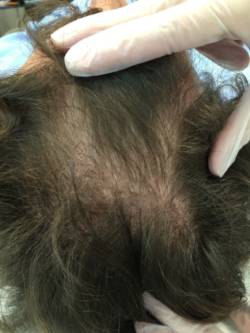 ALOPECIA_1