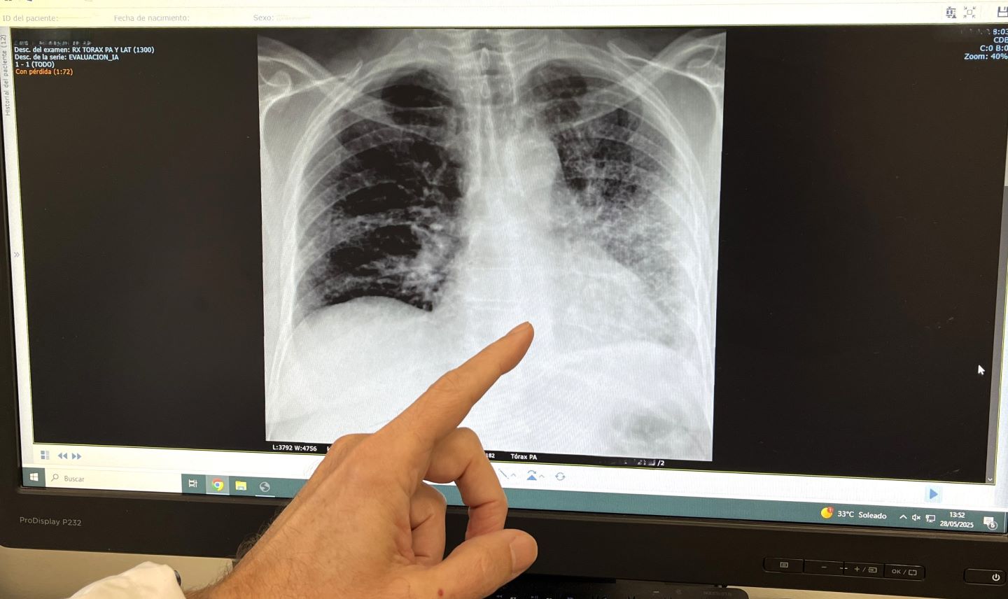 Foto RX paciente fumador con cáncer de pulmón web