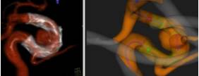 ARTERIOGRAFIA_Y_SIMULACION_VIRTUAL_PREVIA