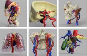 2021 05 26 Varios ejemplos de modelos quirúrgicos personalizados en 3D