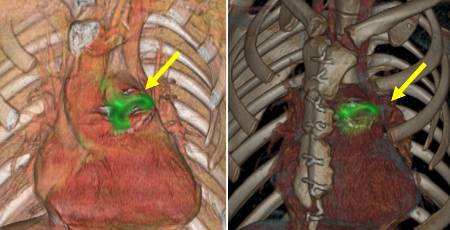 Endocartitis valvular pulmonar