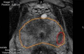 PROSTATA_Y_TUMOR